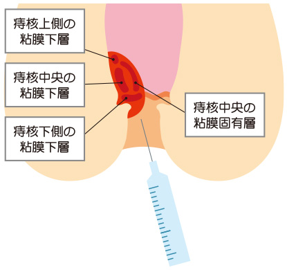 ALTA療法（ジオン注射）