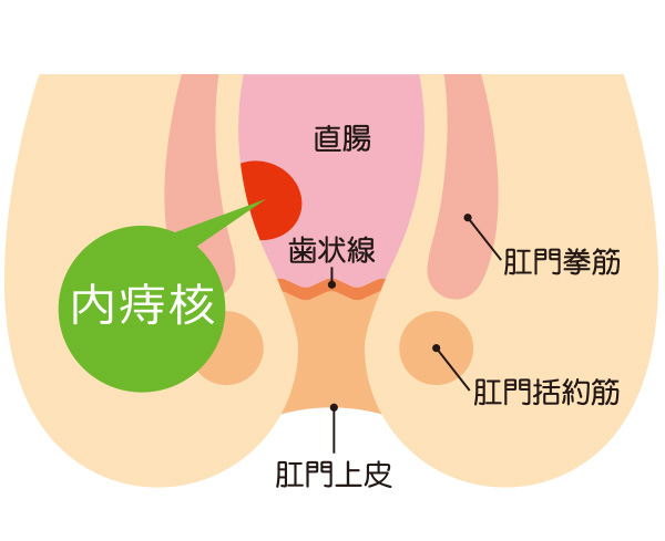 治療 いぼ 痔