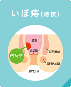 いぼ痔（痔核）