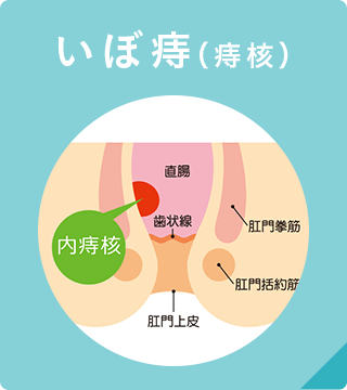 いぼ痔（痔核）