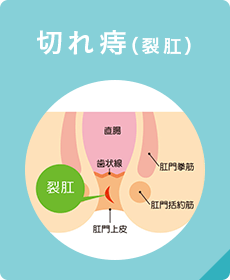 切れ痔（裂肛）