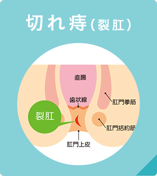 切れ痔（裂肛）